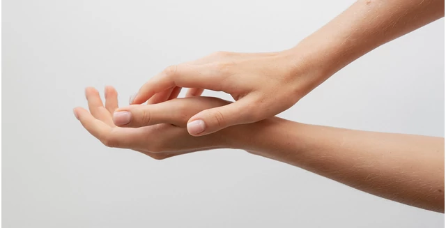 Megelőzhető az ekcéma?